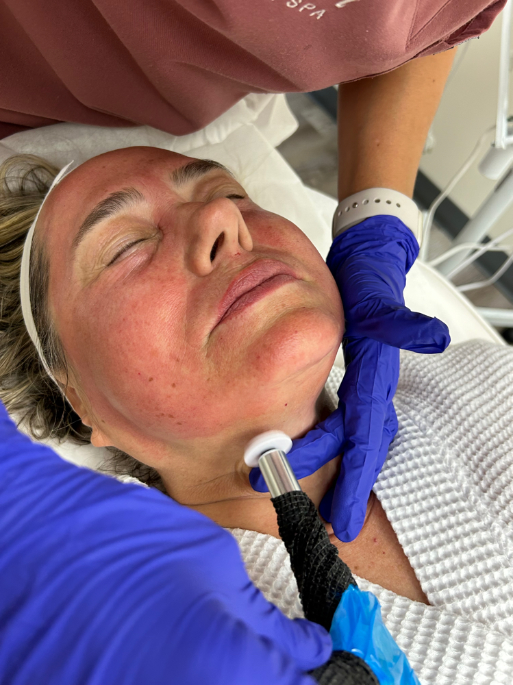Microchanneling Collagen Induction