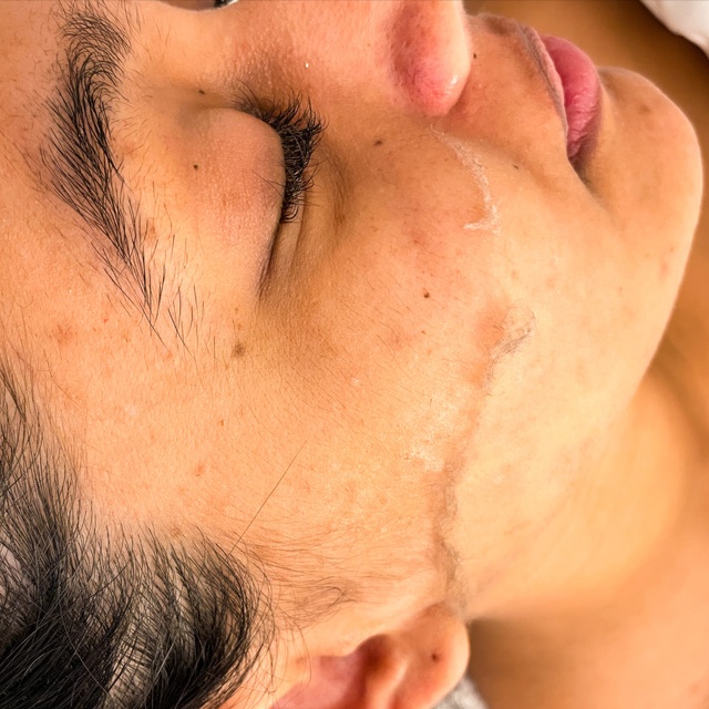 Dermaplane Facial at Moss & Moon in Pflugerville, TX
