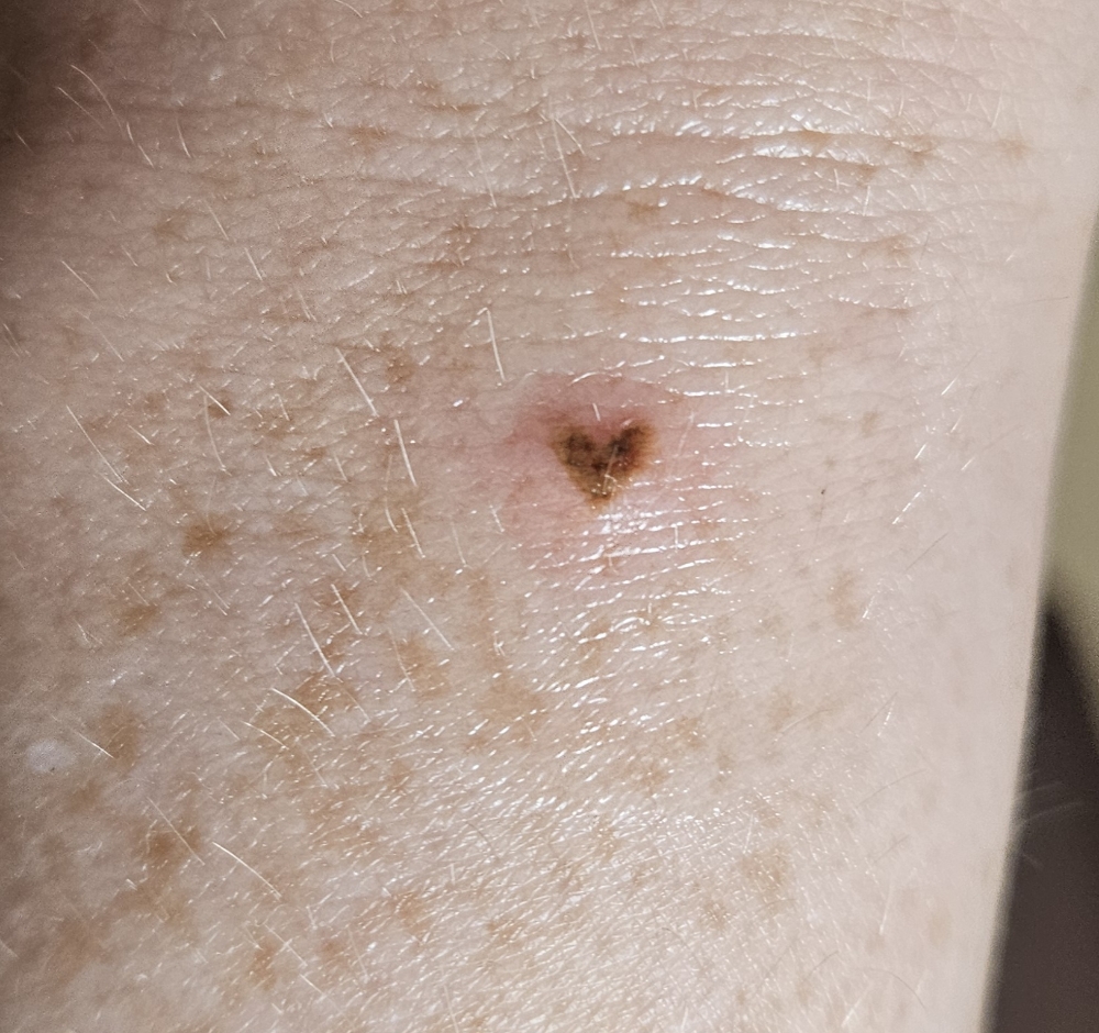 Heart Freckle