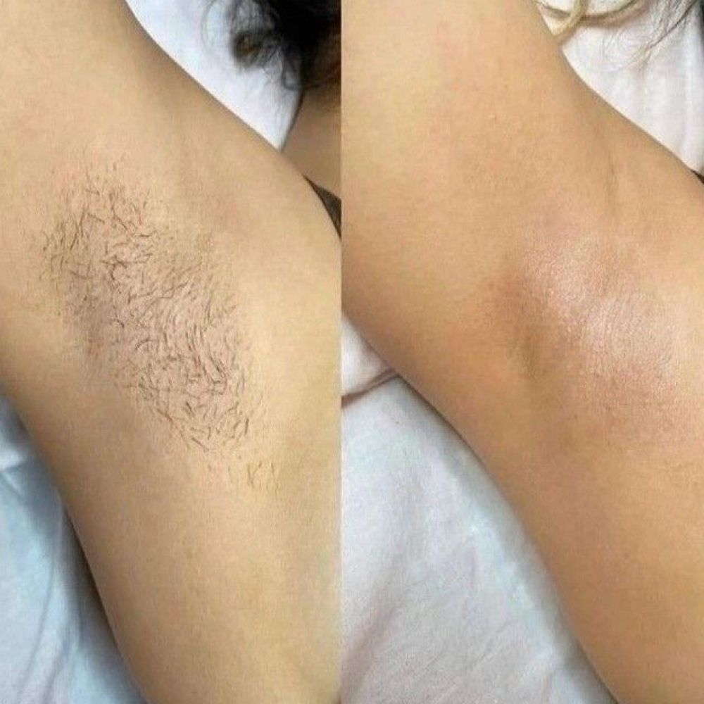 Underarm at SKIN FIX in Colton, CA