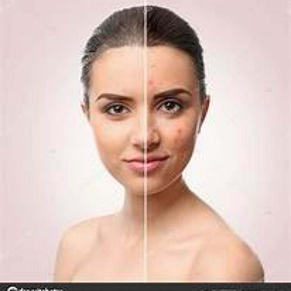 Acne Clearing Facial at Rose Paganelli Me Time Wellness in Georgetown, MA