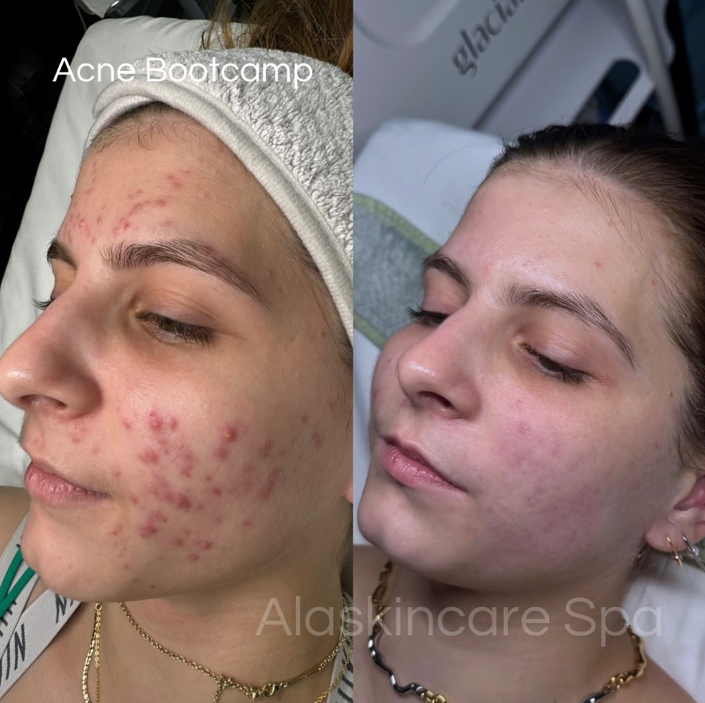 Acne Bootcamp Maintenance