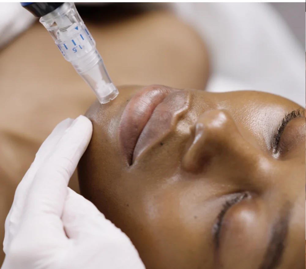 Micro Needling