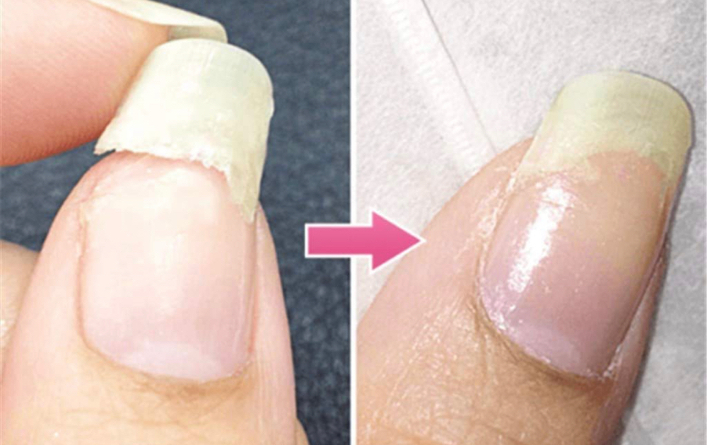 Nail Repair