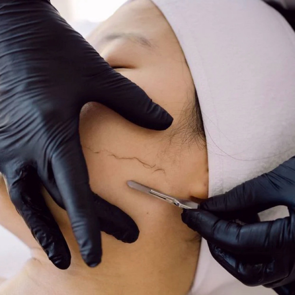 Dermaplane at Velin Beauty in Redwood City, CA