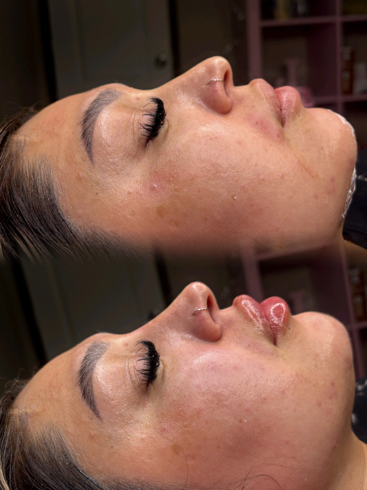 Facial Balancing at PuraGlow Aesthetic in Oklahoma City, OK