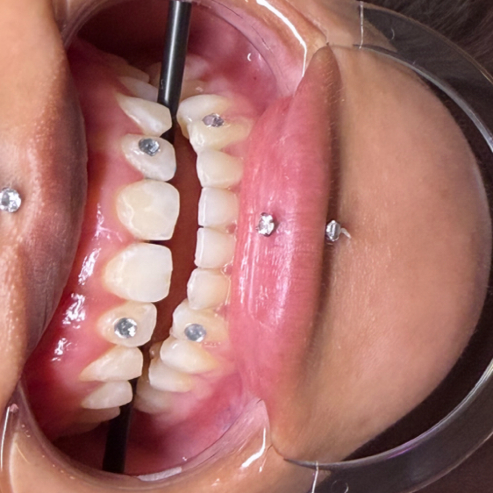 tooth gems at millionaireminks in Houston, TX