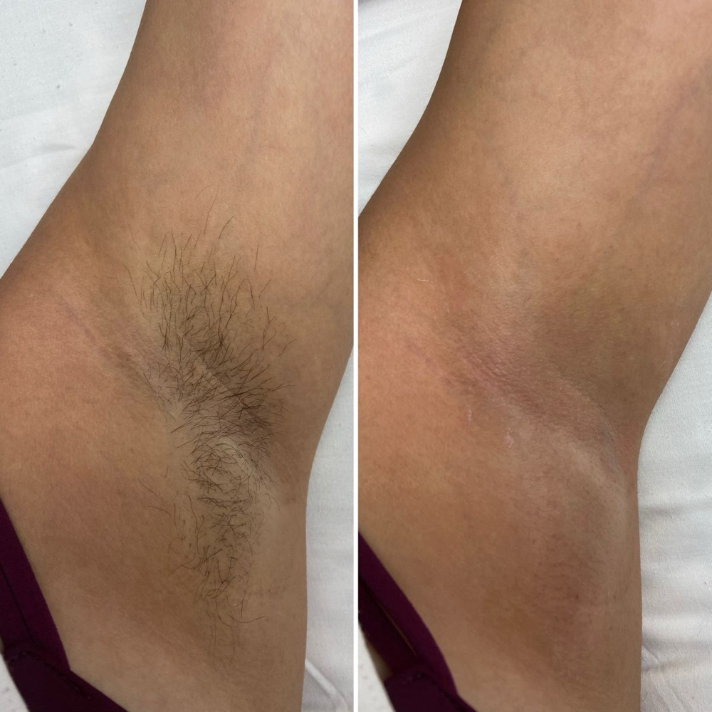 UNDERARM WAX at anele skin studio in SUMMERFIELD, NC