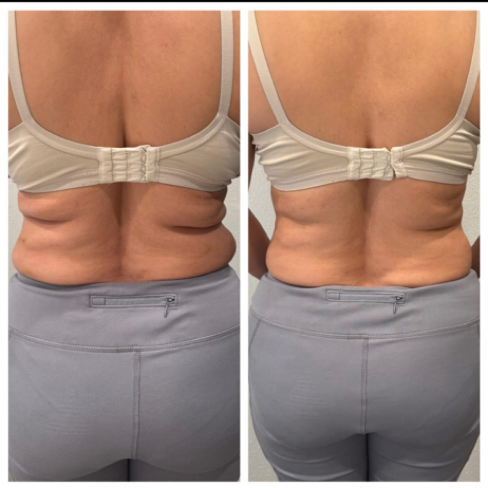 Lipo dissolve at The Virtuous Glow in Roswell, NM