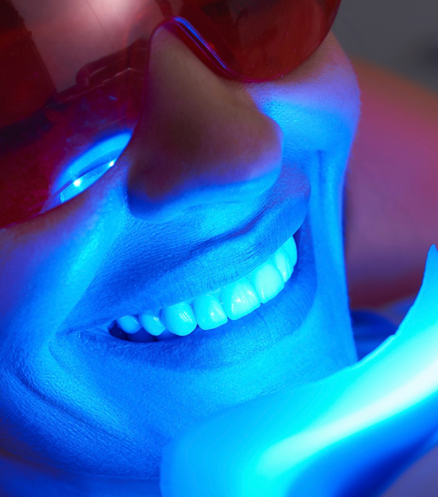 Teeth Whitening