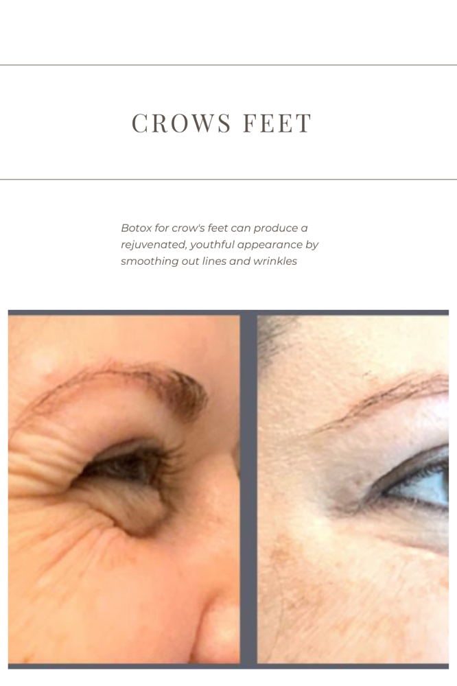 Crows Feet
