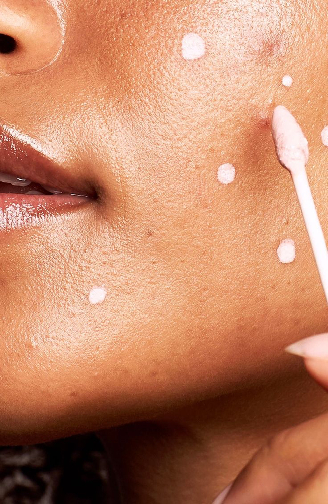 Acne Treatment
