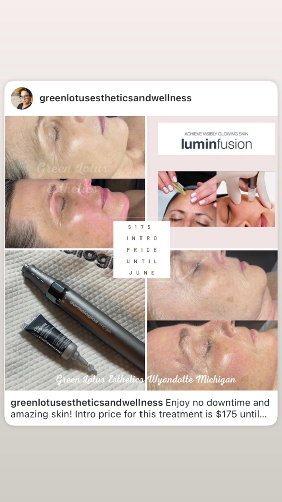 3 LuminFusion Treatments