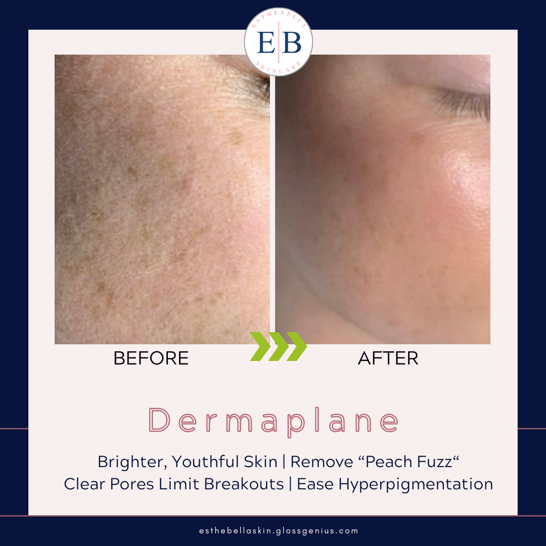 Dermaplane Facial