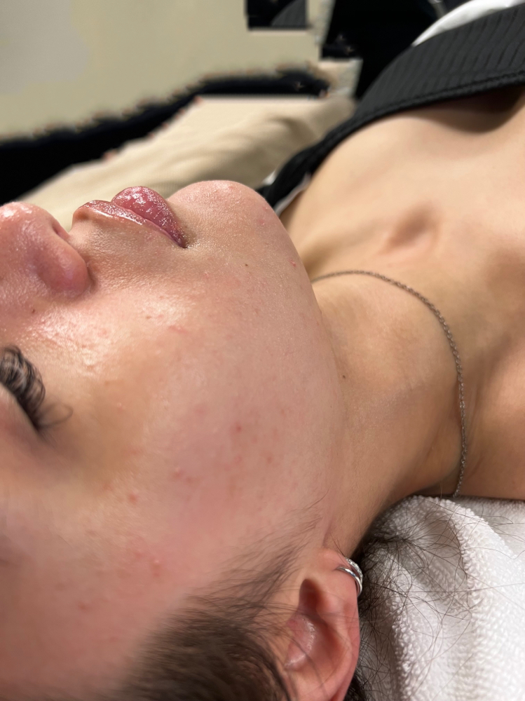Dermaplaning