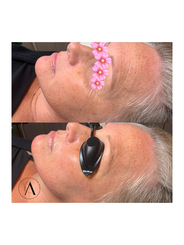 Hyalnano Filler Treatment