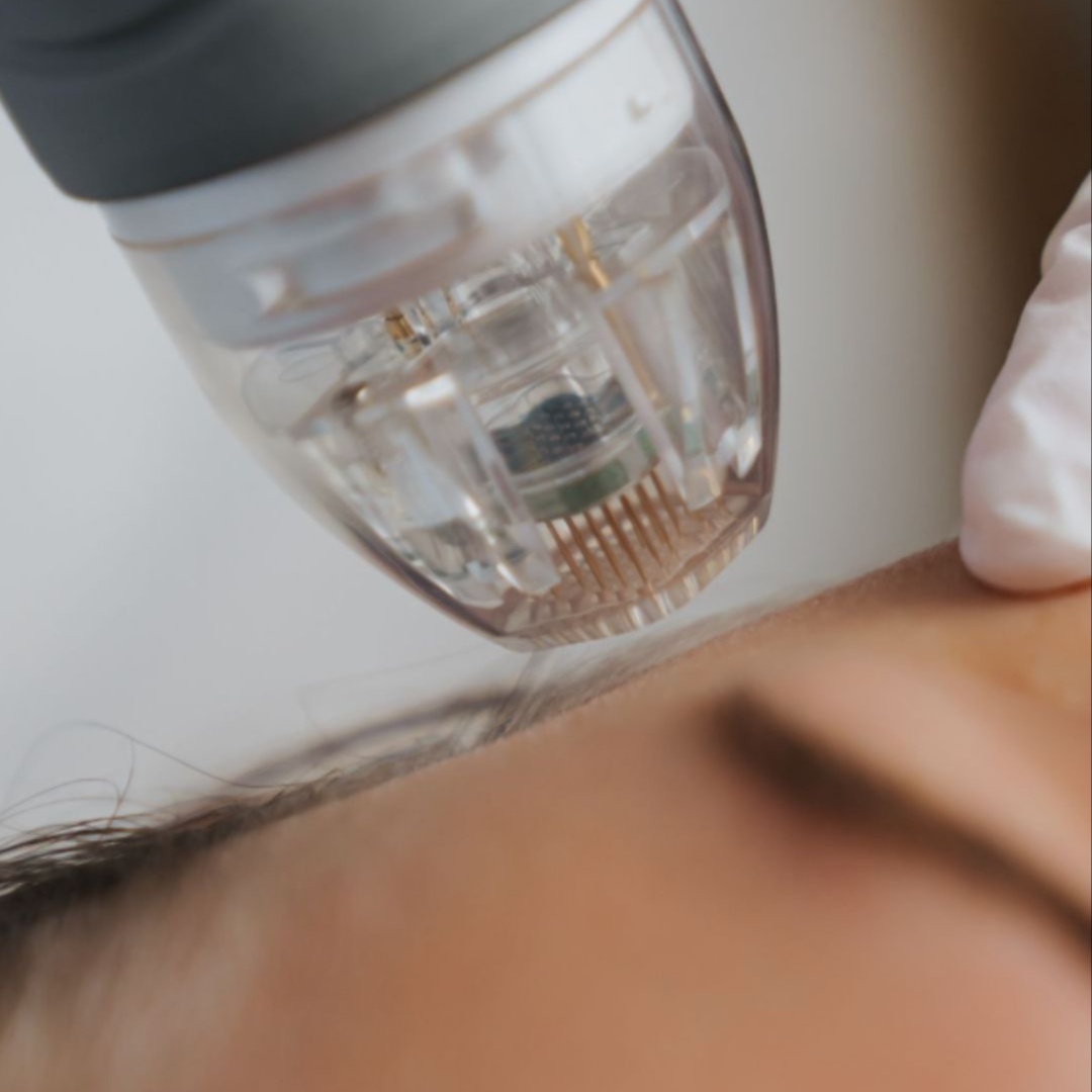 Microneedling - Radio Frequency at RSB Med Spa in Kansas City, MO