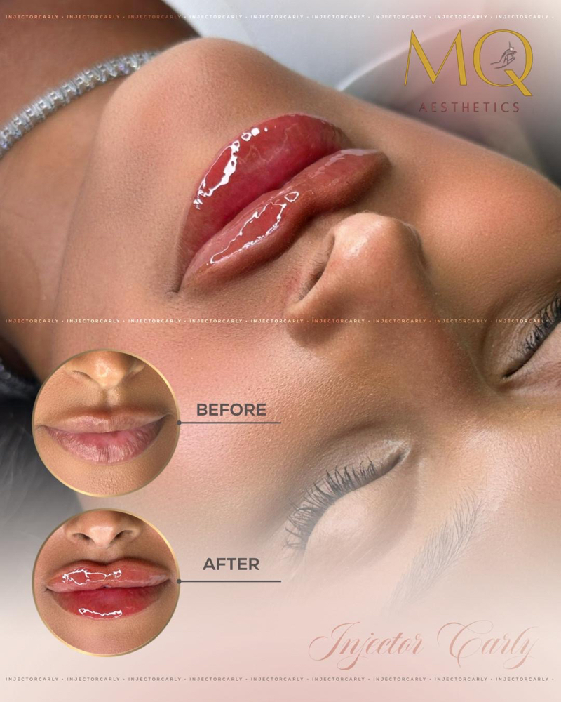 1ML Needle Lip Filler