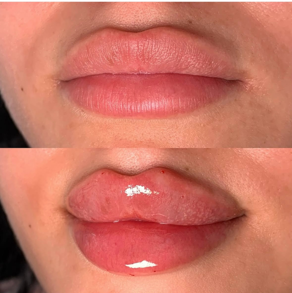 Needle Lip Filler