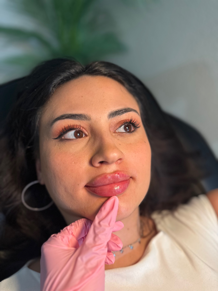 1ML Needle Lip Filler