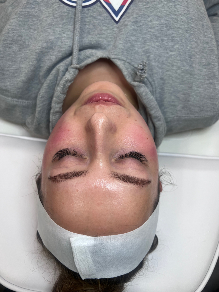 Jessner’s Chemical Peel