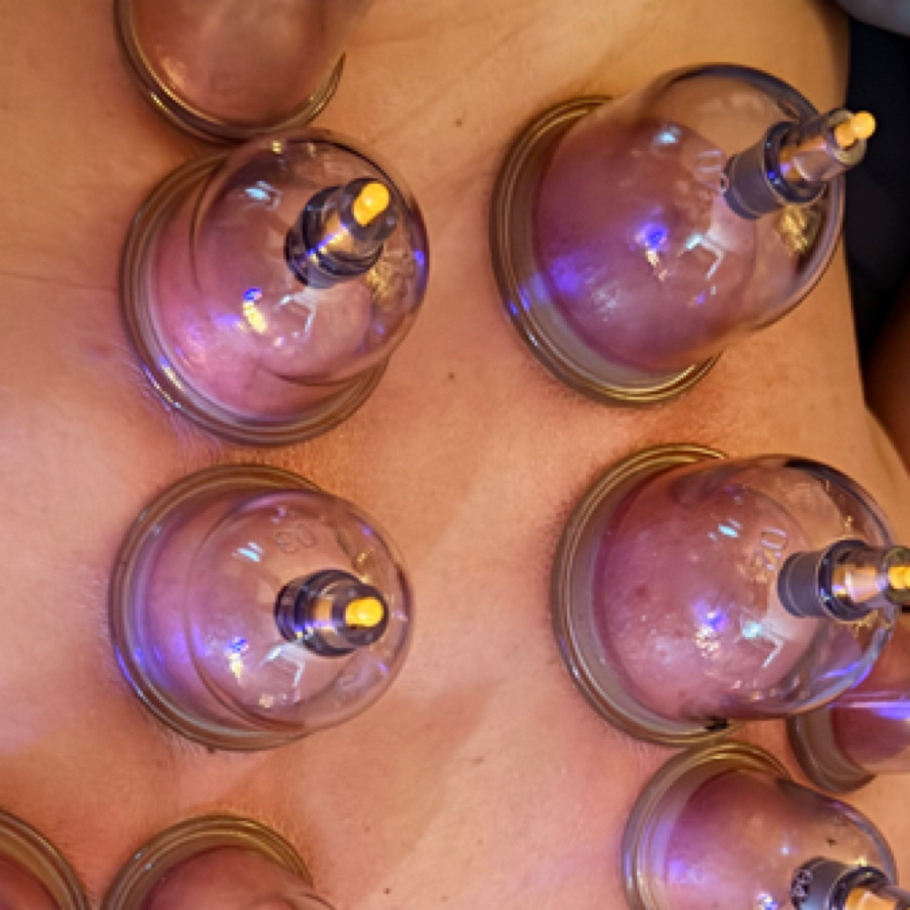 Cupping Therapy at Joni’s stretching massages in Sidney, OH
