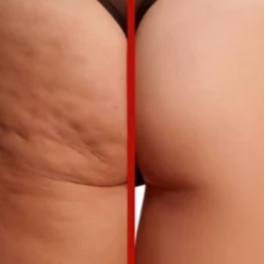 Cellulite Reduction w/ Wood Therapy at Skin Retribution in Folsom, CA