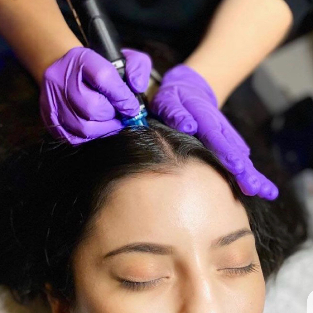 Scalp Hair Growth Microchanneling at Everlasting Beauty By Natachia in Farmingdale, NJ