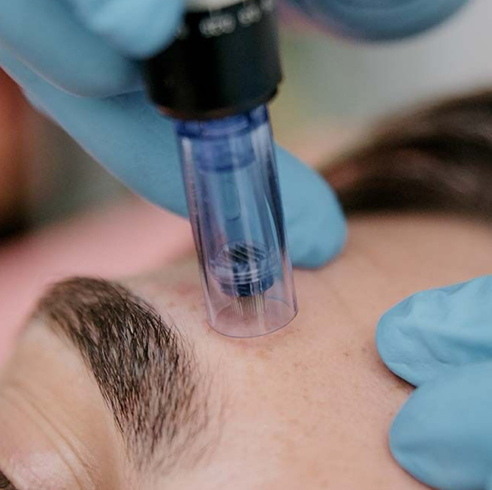 Dermapen Treatment at Vanessa Yarce in Miami, FL