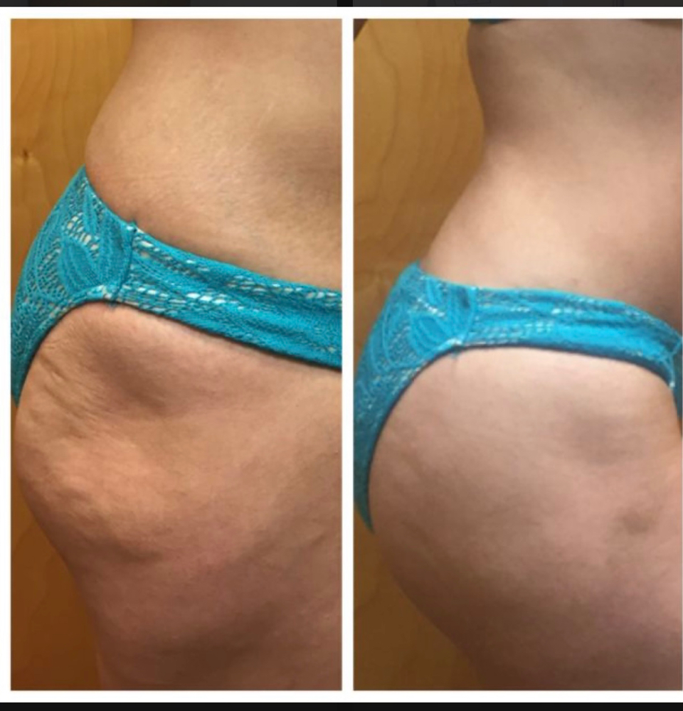 Non-Invasive BBL