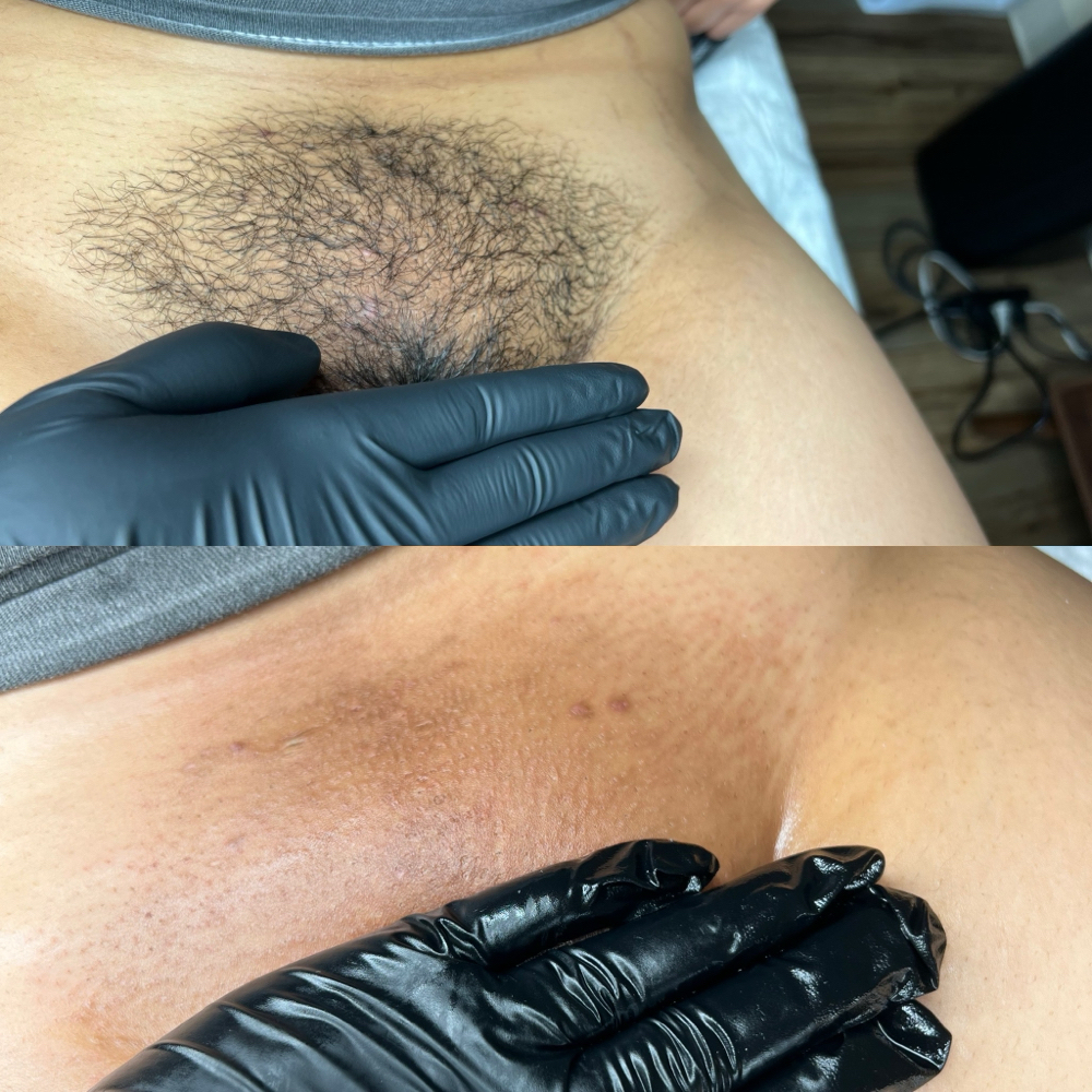 Full Brazilian Wax