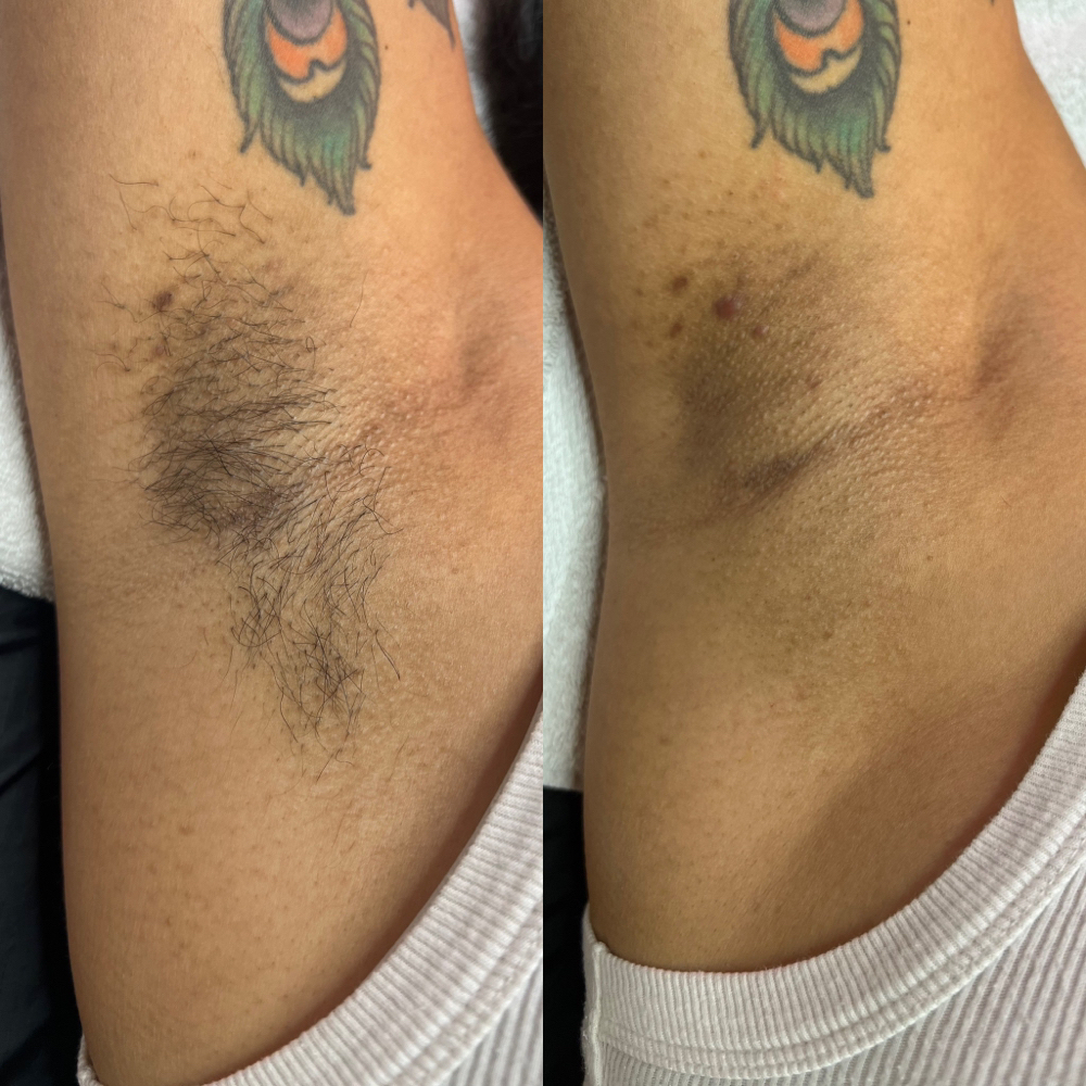 Underarm Hair Removal