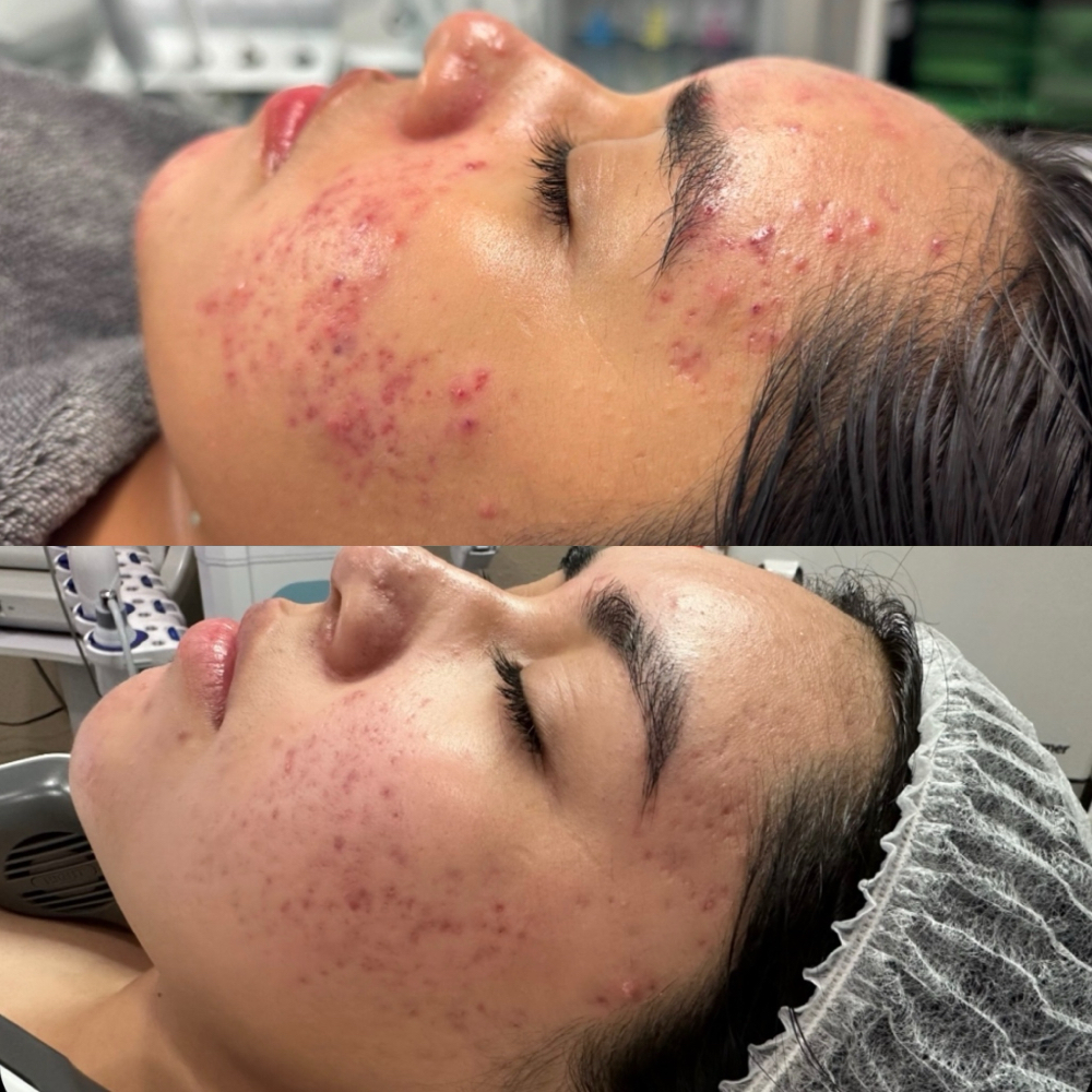Skin Reset Bundle (3 Sessions) at Fountain of Youth Spa in Yuma, AZ