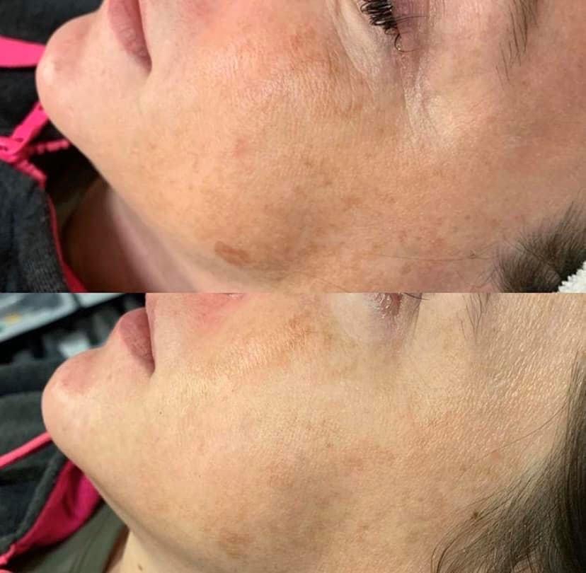 Vitamin A Chemical Peel