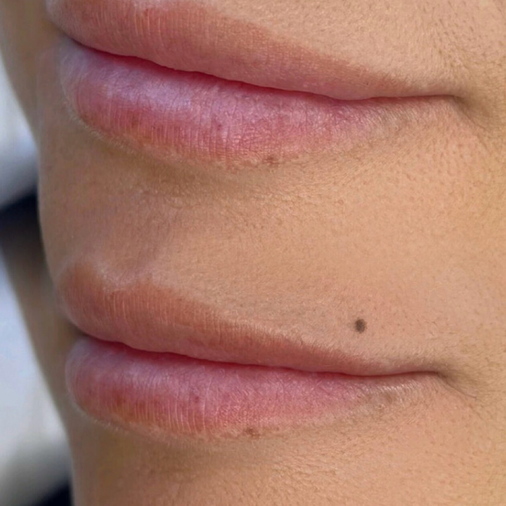 Beauty Mark at Rewind Med Spa in Longmont, CO
