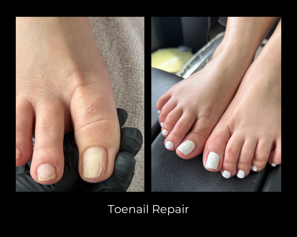 Toenail Repair With Gel