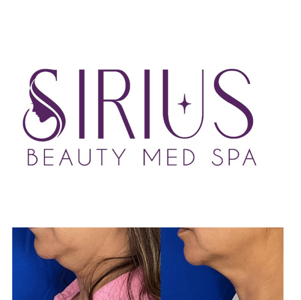 Reduccion De Papada -Double Chin