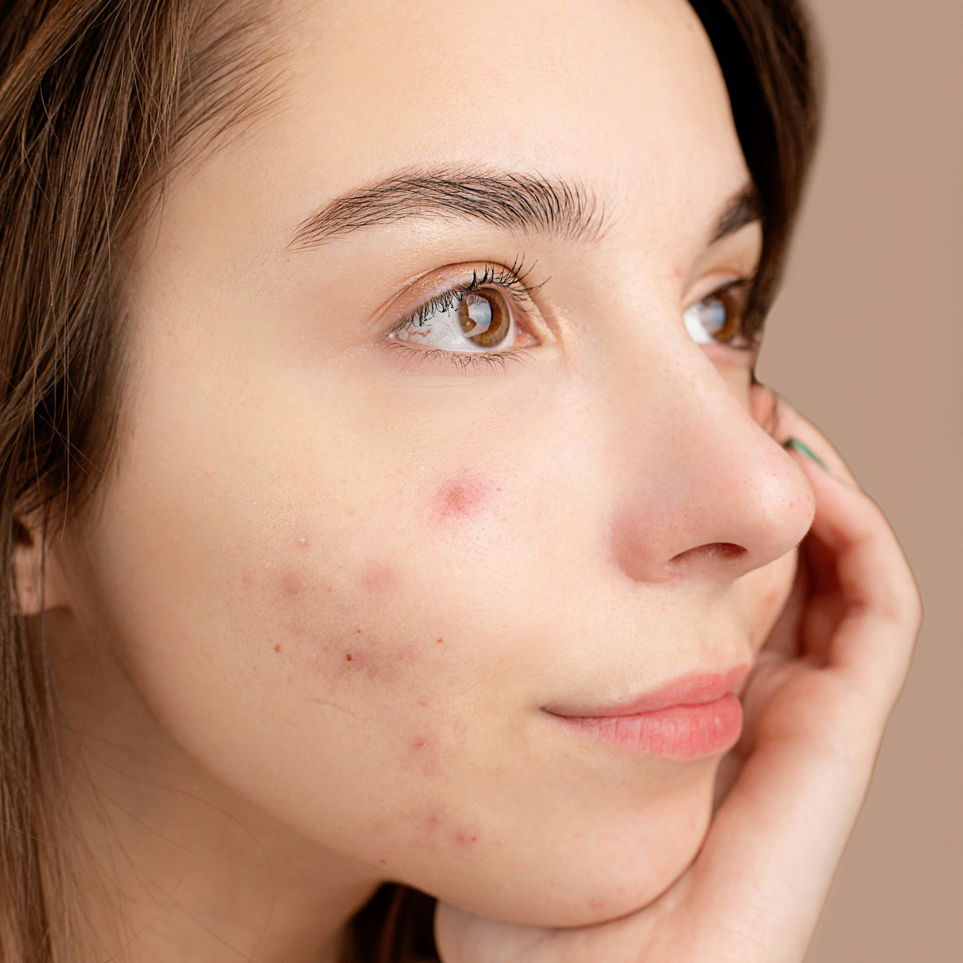 Clear Complexion at Miss Me Esthetics Med Spa on Main in Canon City, CO