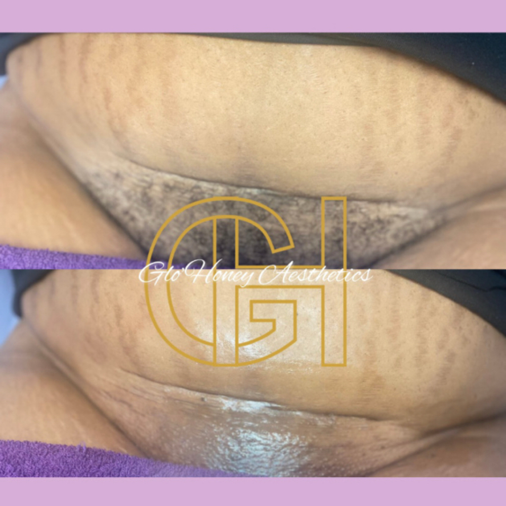 Brazilian Wax