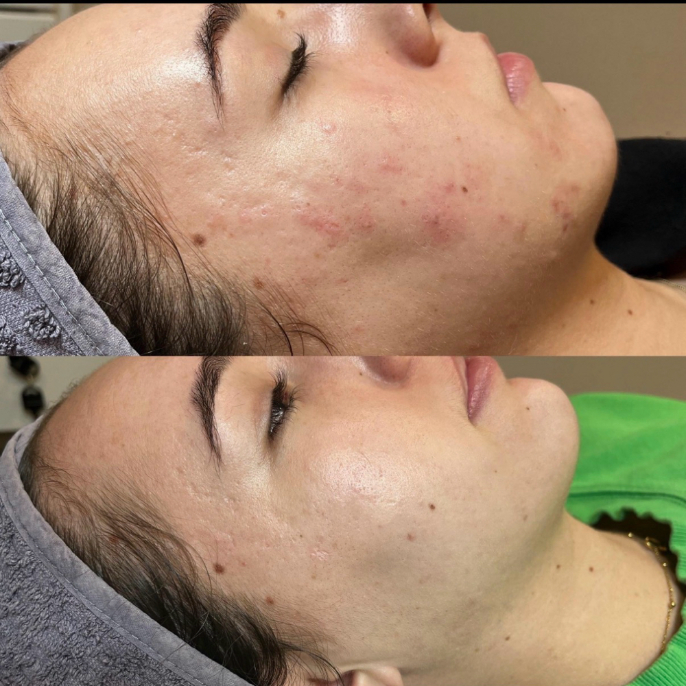 Glycolic70 at Alchemy Health Aesthetic Beauty LLC in Indianapolis, IN