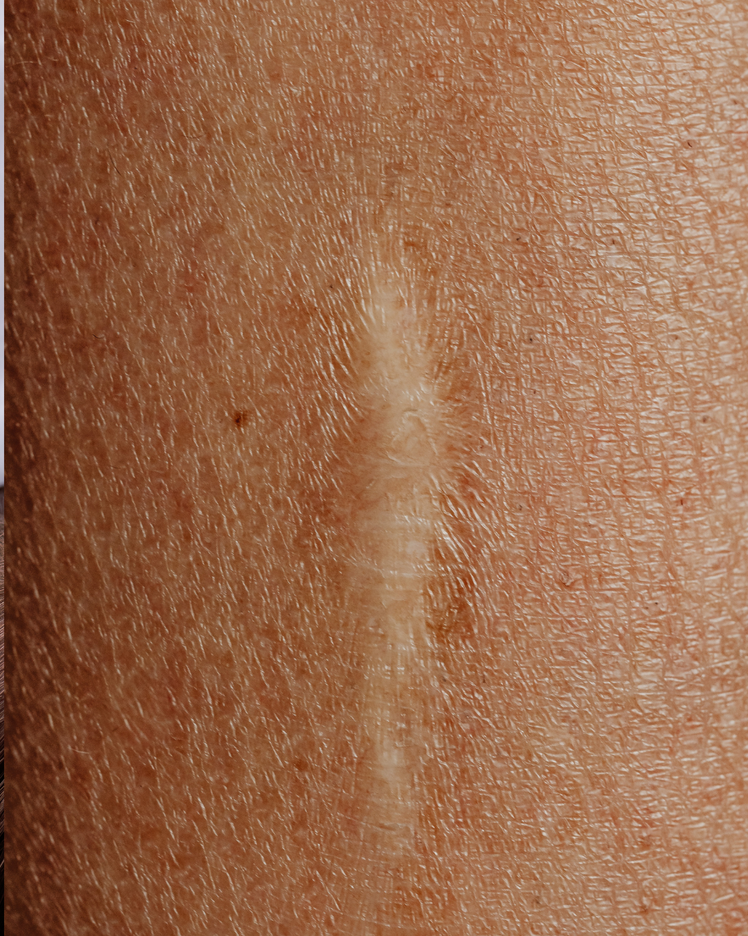 Scar/Stretch Mark Camouflage Model