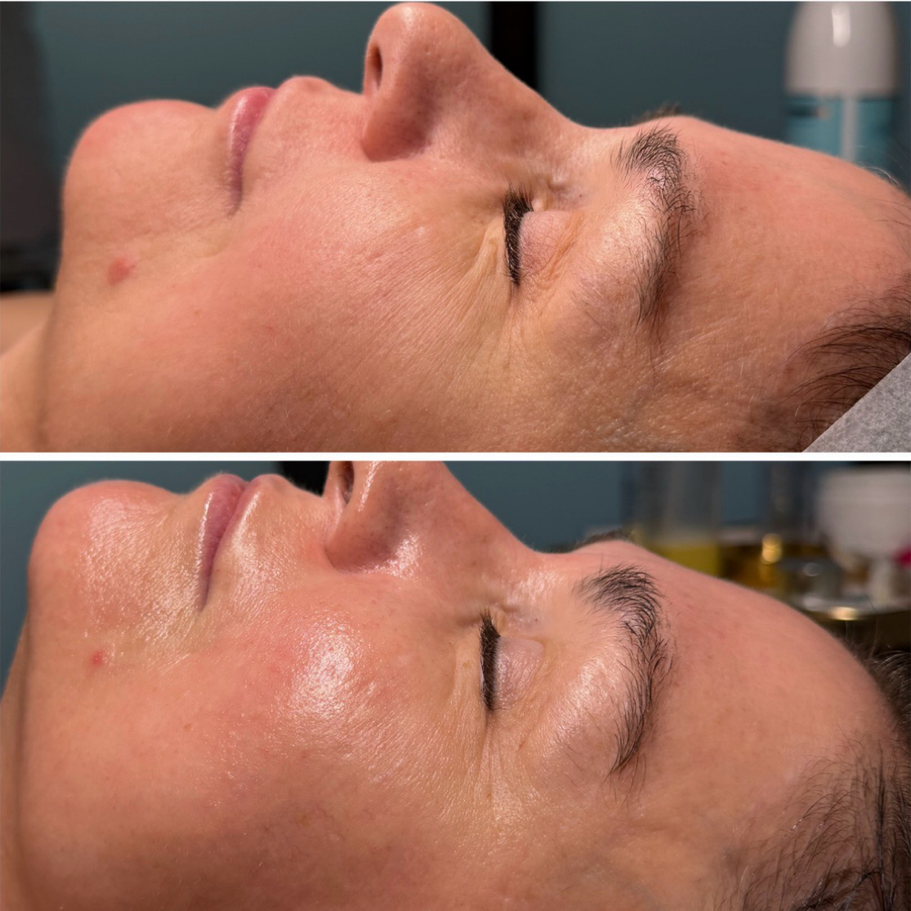 The “CO2  Luxe Lift “ Treatment at Skinplicity Facial Spa in Jurupa Valley, CA