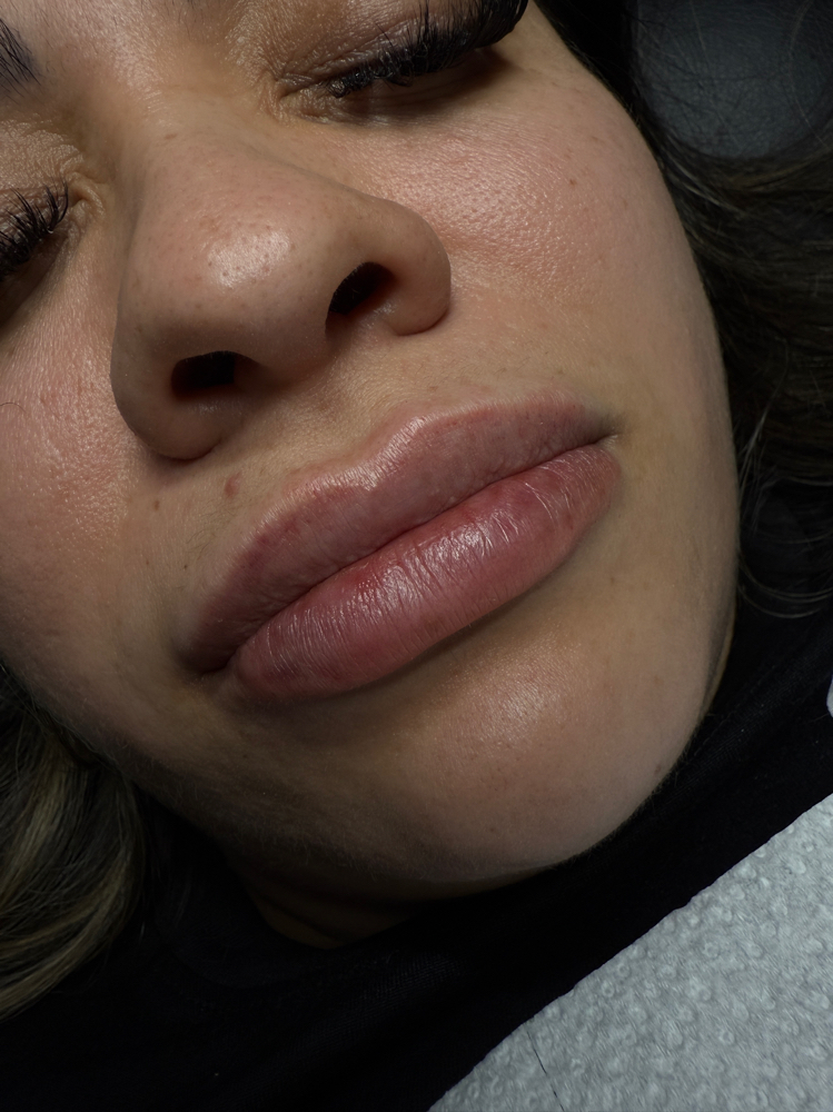 Lip Filler Touch up