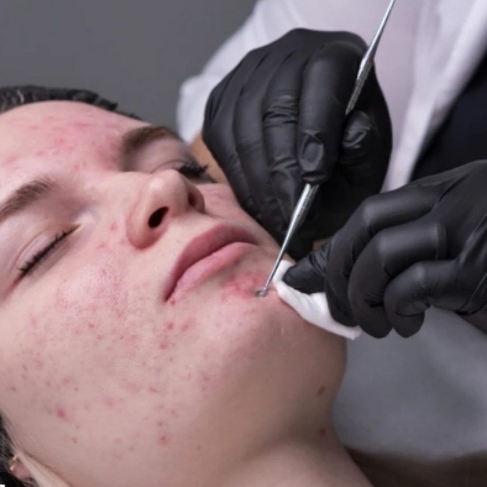 Acne Clarifying Facial at Sun Skincare LLC in Scottsdale, AZ
