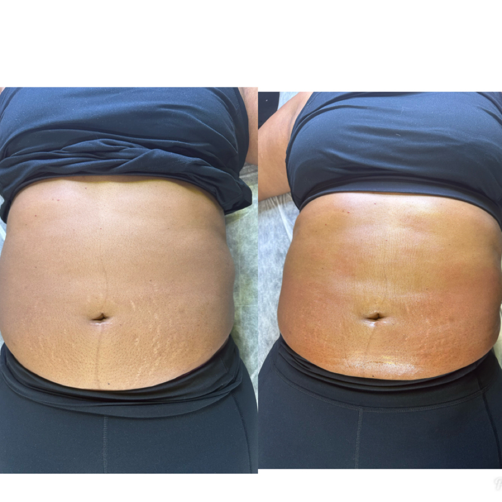Stomach Sculpt + Tighten at Waxxaholics Beauty & Body in Grand Prairie, TX