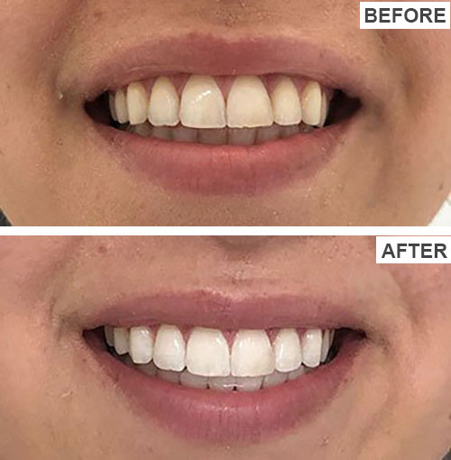 Rapid Teeth Whitening