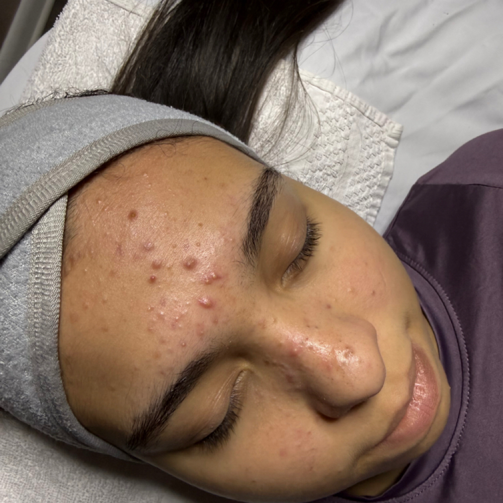 Acne Extraction Facial at Mjzlamouresthetic in Brandon, FL