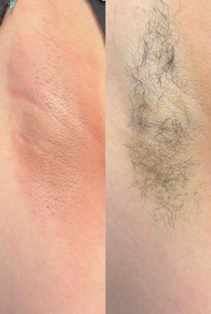 Underarm at Golden Vanity Aesthetics in Riverside, CA