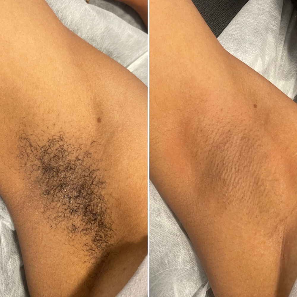 Underarm Wax