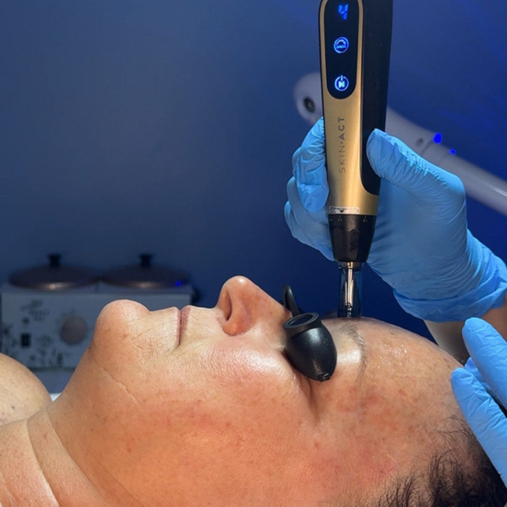 Microneedling at Skinfinity & Beyond in Davidson, NC